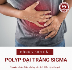 Polyp đại tràng sigma là gì: Tìm hiểu nguyên nhân, biến chứng và cách điều trị 